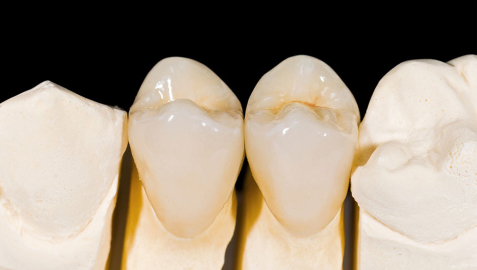 E-Max Crowns