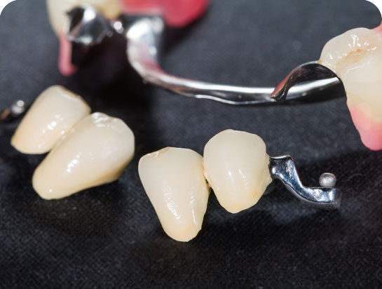 Dental prostheses