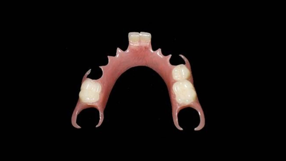 Partial Flexite prosthesis